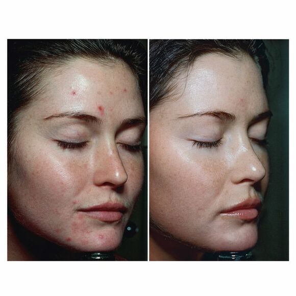 Somme Institute Exfoliating Transport Pads - Picture 5 of 13